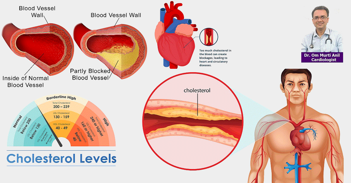 کلسترول و تری گلیسیرید بالا چه نشانه هایی دارد