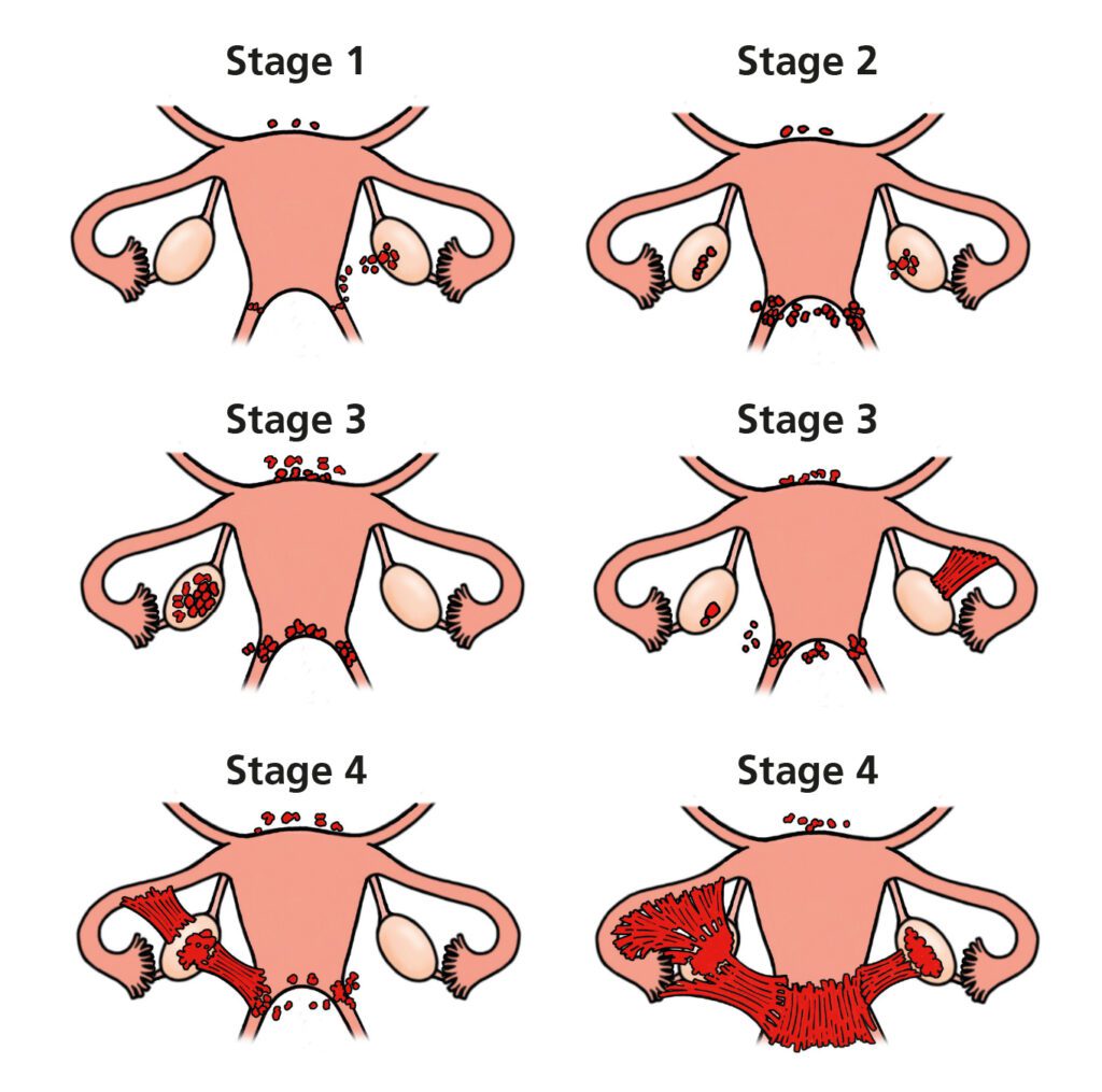 مراحل آندومتریوز