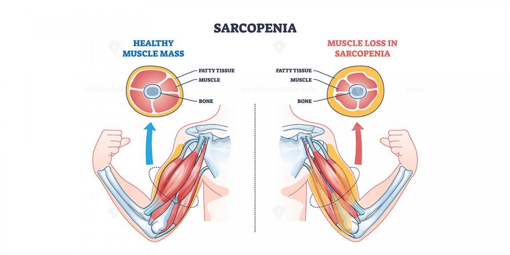 سارکوپنی چیست؟